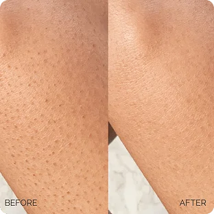 Before and After Marée Acid Pads
