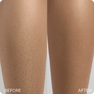 Before and After Marée Acid Pads