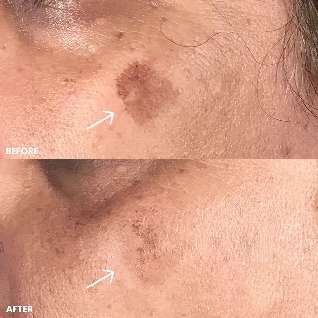 Corrects Uneven Pigmentation