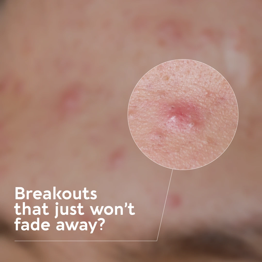 Breakouts
