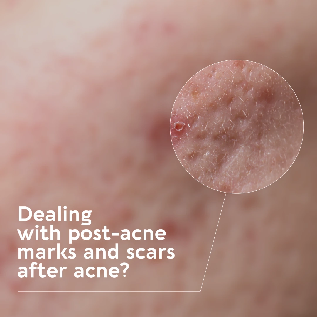 Dealing with post-acne