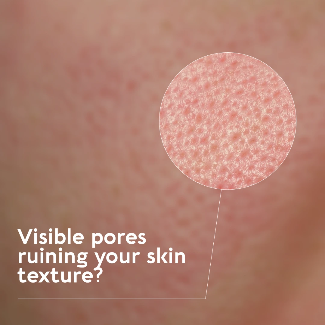 Visible pores