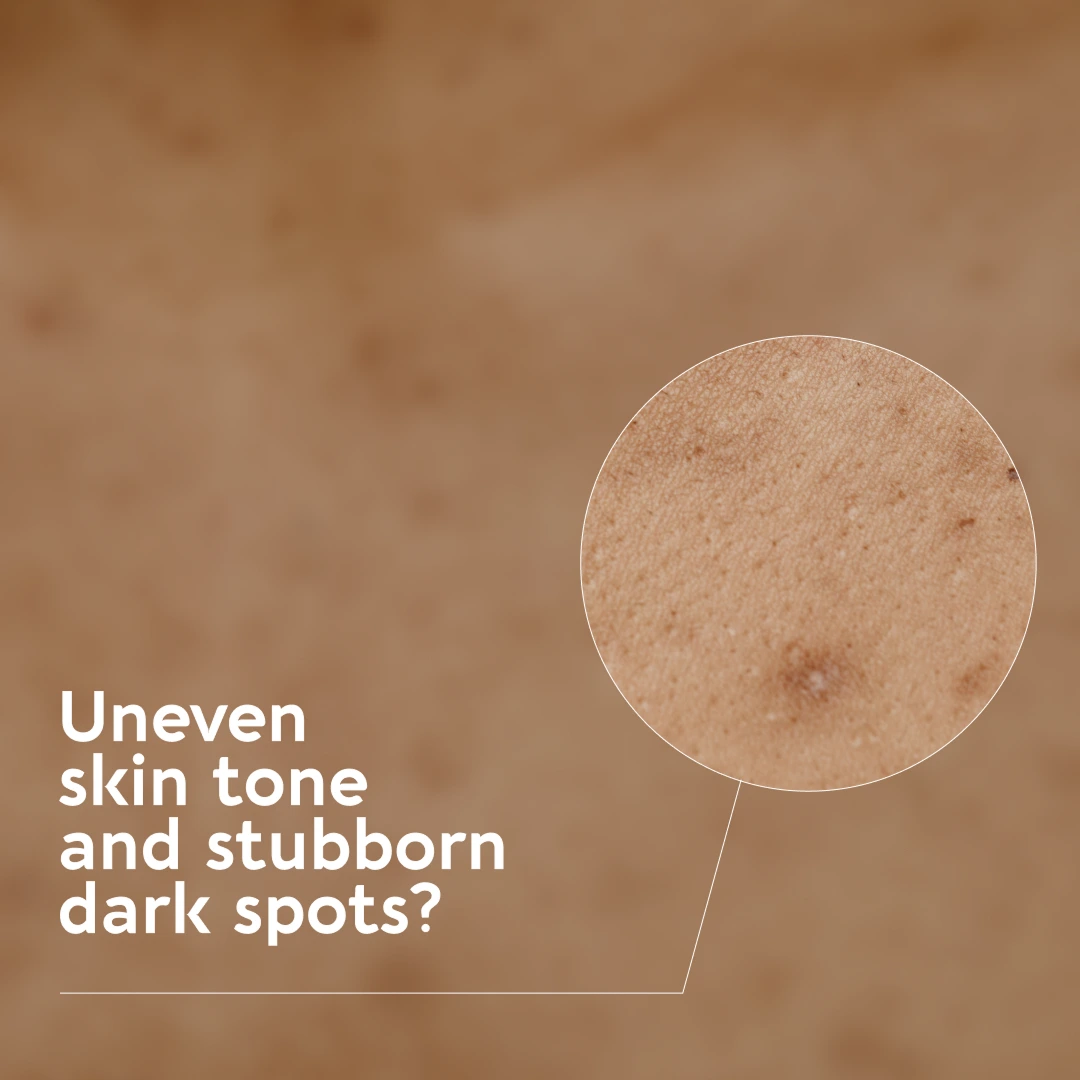 Uneven skin tone
