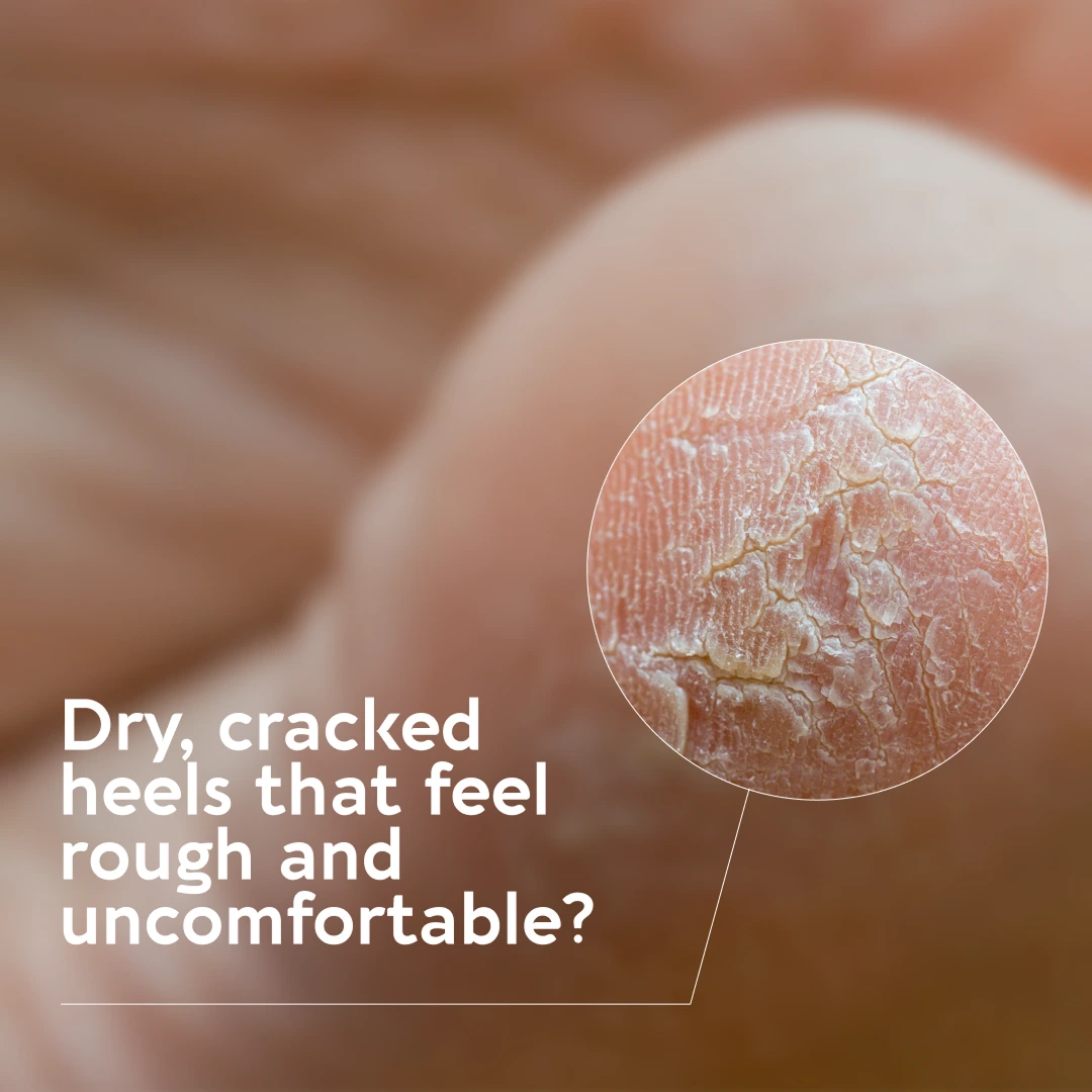 Dry, cracked heels