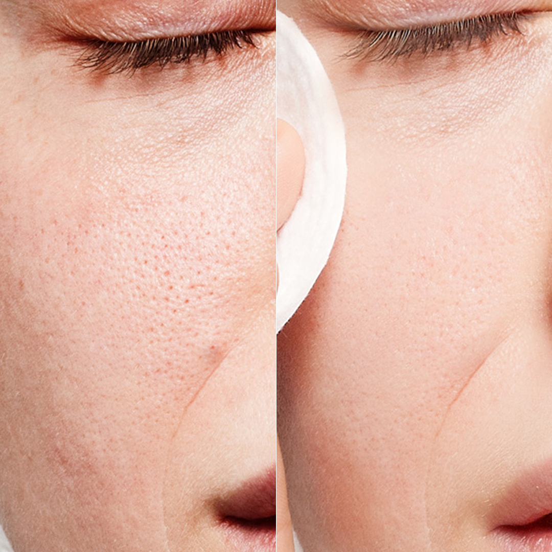 Maree Glycolic Acid Exfoliating Pads Before After First