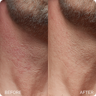 Maree Glycolic Pads for man before / after