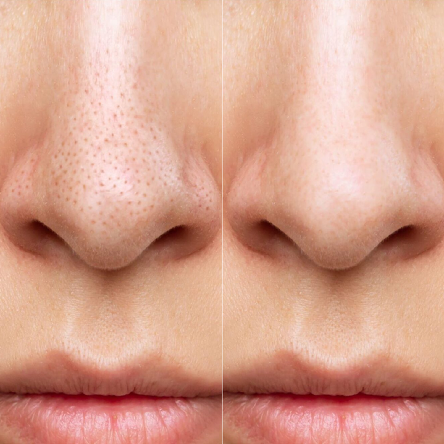 Maree Glycolic Acid Exfoliating Pads Before After Nose
