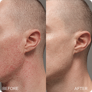 Maree Glycolic Pads before / after