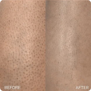 Maree GLYCOLIC Pads before and after